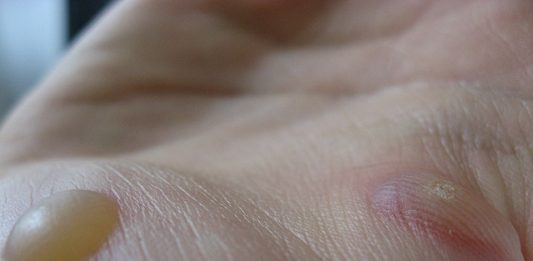 סובלים משלפוחיות על העור?