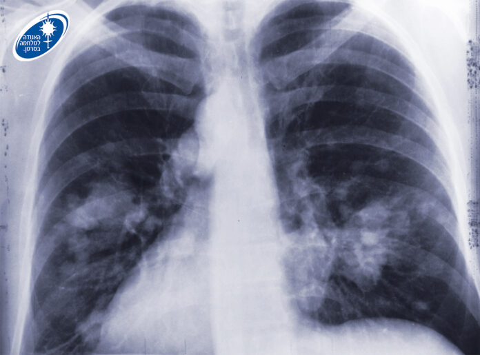 סרטן-ריאות - האגודה למלחמה בסרטן --01